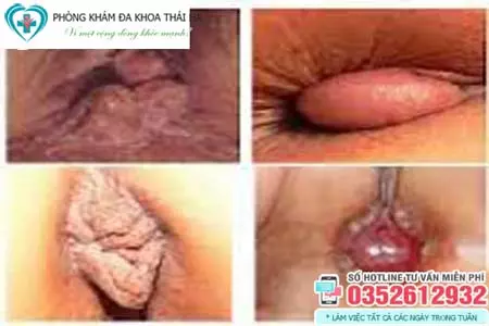 Hình ảnh của bệnh trĩ ngoại