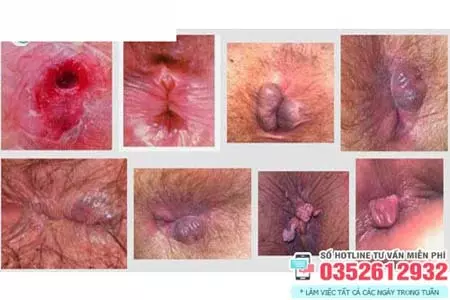 Hình ảnh bệnh trĩ ngoại độ 3