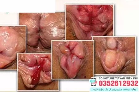 Hình ảnh trĩ ngoại độ 4 tắc mạch