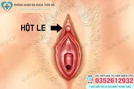 Nổi mụn ở hột le