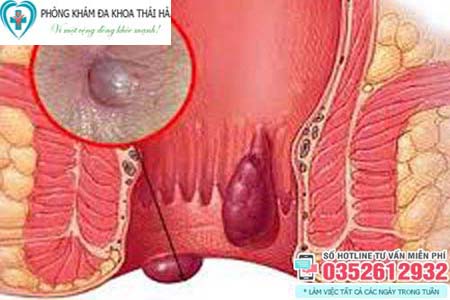 Bệnh trĩ