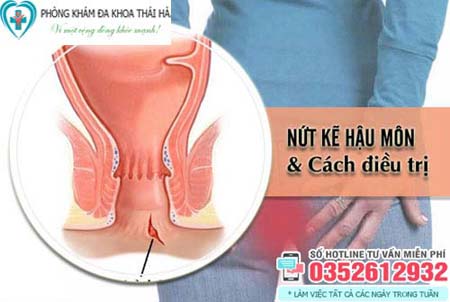 Nứt kẽ hậu môn