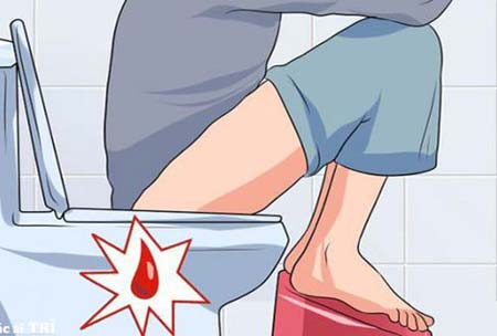 Đại tiện ra máu nhưng không đau