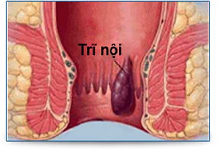 Hình ảnh hậu môn bị trĩ nội