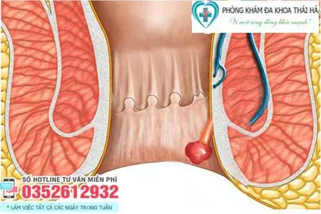 Polyp hậu môn