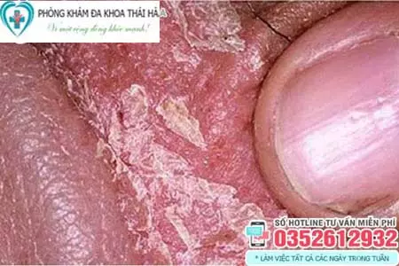 Dương vật bị tróc da là bệnh gì