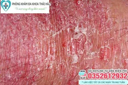 Dương vật tróc da ngứa