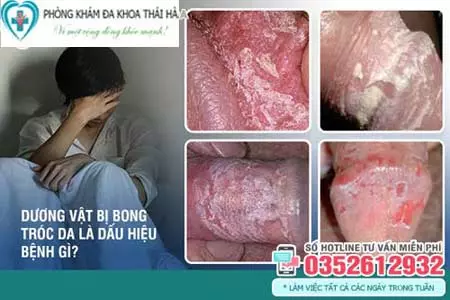 Trị dương vật bị tróc da