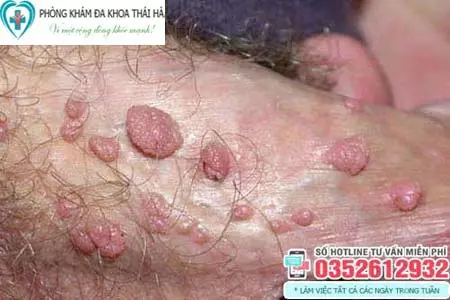 Hình ảnh nổi mụn thịt ở thân dương vật do Sùi mào gà