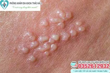 Dương vật nổi mụn thịt trắng do mụn rộp sinh dục