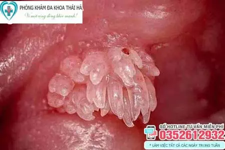 Mọc mụn thịt ở dương vật
