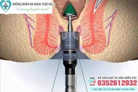 Review cắt trĩ