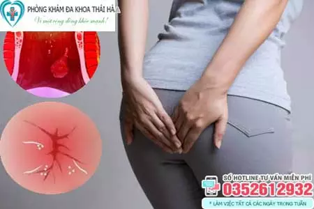 Dấu hiệu nhiễm trùng sau khi mổ trĩ
