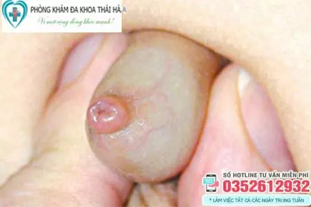 Hình ảnh bao quy đầu bị dính ở trẻ em