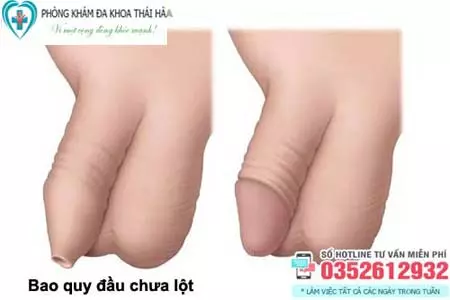 Bao nhiêu tuổi thì lột bao quy đầu