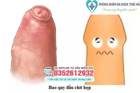 Hình ảnh chít hẹp bao quy đầu