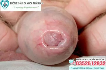 Hình ảnh hẹp bao quy đầu ở trẻ nhỏ