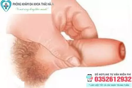 Hình ảnh hẹp bao quy đầu ở người lớn