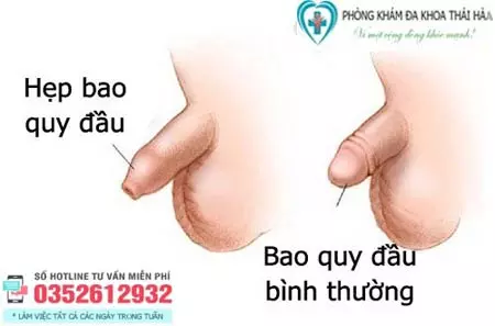 Hình ảnh bao quy đầu hẹp và bao quy đầu bình thường