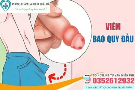 Bệnh viêm bao quy đầu là gì?