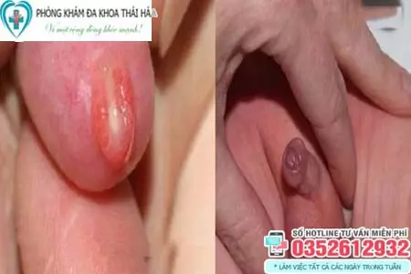 Hình ảnh viêm bao quy đầu ở trẻ nhỏ