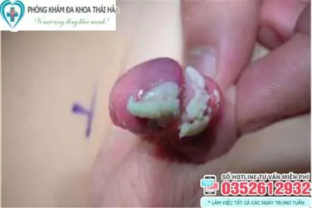Hình ảnh trẻ bị viêm bao quy đầu