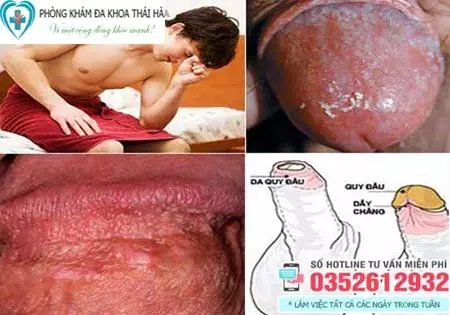 Cách chữa viêm bao quy đầu
