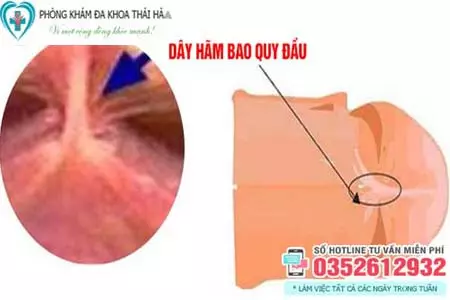 Cắt dây hãm bao quy đầu là gì?