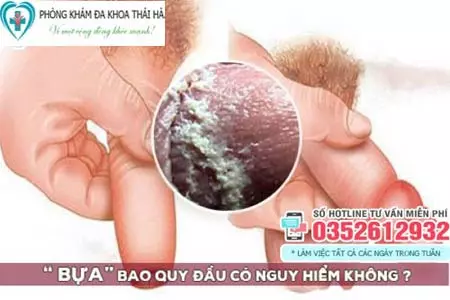 Bựa trắng ở bao quy đầu