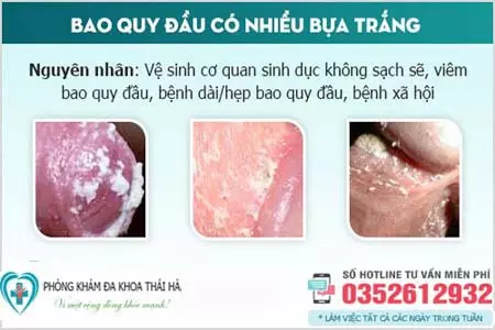 Bao quy đầu có mảng trắng