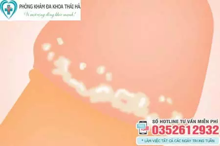 Đầu dương vật xuất hiện mảng trắng