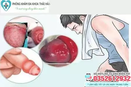 Dấu hiệu nhiễm trùng sau khi cắt bao quy đầu
