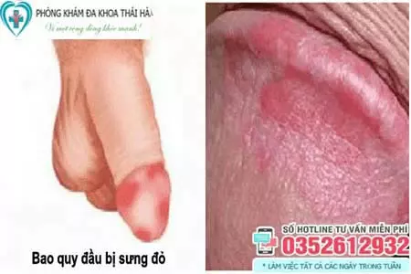 Hình ảnh nhiễm trùng sau khi cắt bao quy đầu