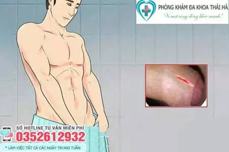 Dương vật bị trầy xước phải làm sao