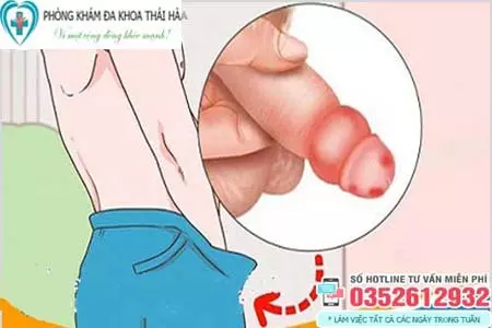 Nghẹt bao quy đầu là gì?