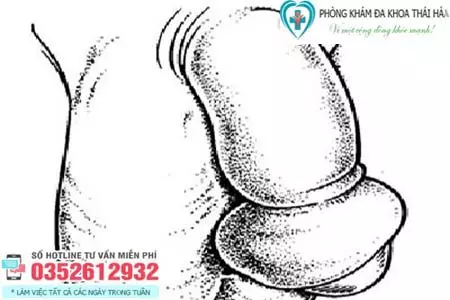 Dấu hiệu nghẹt bao quy đầu