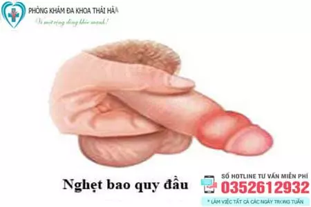 Hình ảnh nghẹt bao quy đầu
