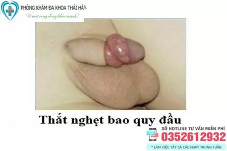 Hình ảnh nghẹt bao quy đầu ở trẻ em