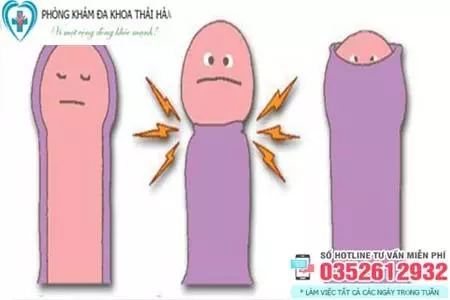 Nghẹt bao quy đầu phải làm gì?