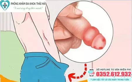 Bao quy đầu bị sưng đỏ và ngứa