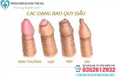 Các bệnh bao quy đầu thường gặp