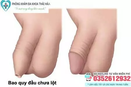 Bao quy đầu chưa lột