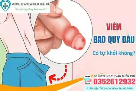 Chữa viêm bao quy đầu tại nhà