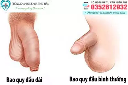 Bao quy đầu dài là gì