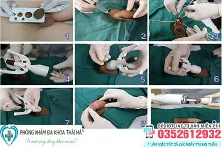 Quy trình cắt bao quy đầu