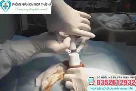 Chi phí cắt bao quy đầu