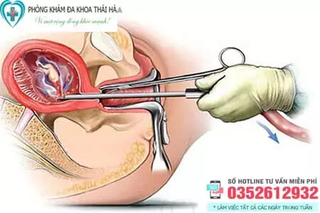 Quy trình hút thai an toàn