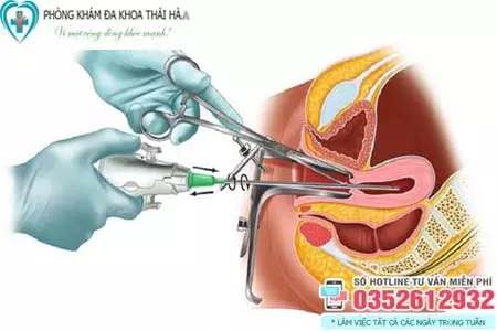 Hút thai chân không có đau không