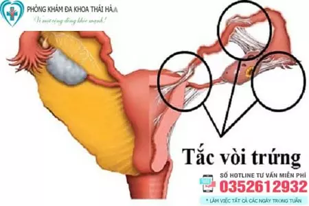 Cách chữa tắc vòi trứng