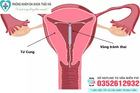 Đặt vòng tránh thai